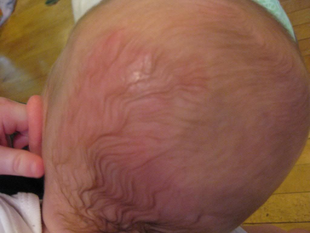 Skin breakdown Day 4 (pics) BabyCenter