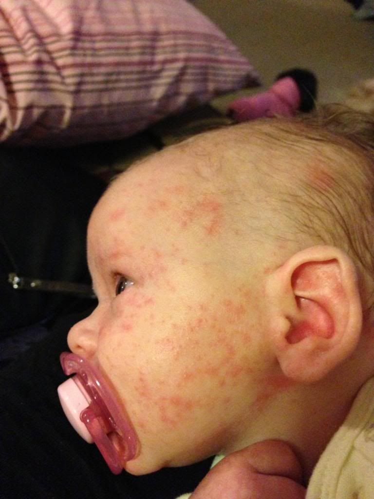 rash-on-baby-face-or-acne-need-advice-pictures-babycenter